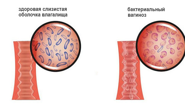 Бактериальный вагиноз — симптомы, лечение